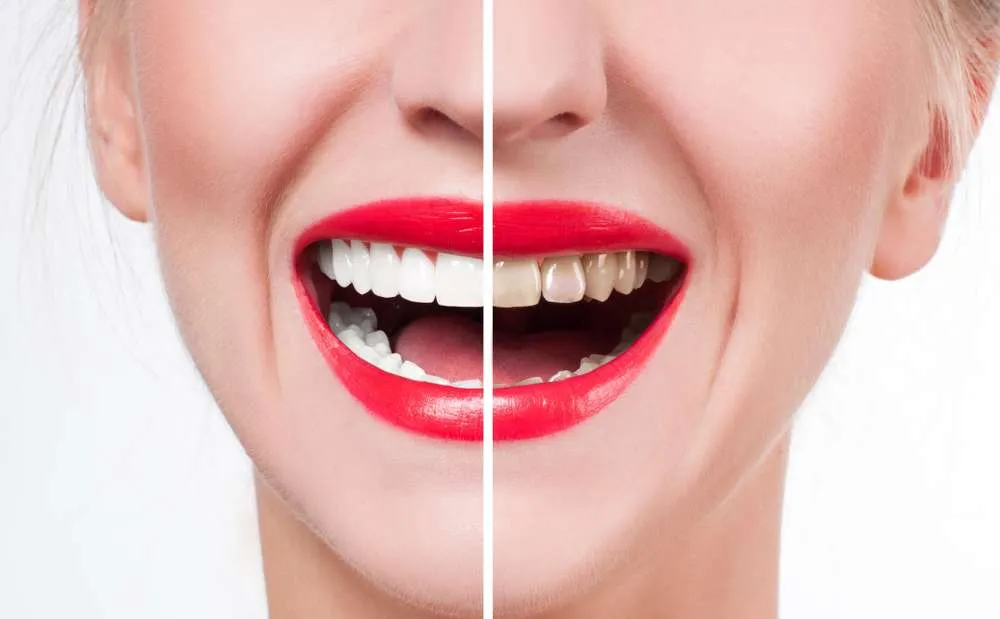 Teeth Whitening for Sensitive Teeth: What You Need to Know Before Starting Treatment