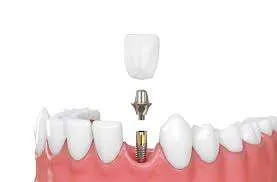 Maintaining Your Dental Implants: Tips for Long-Term Success