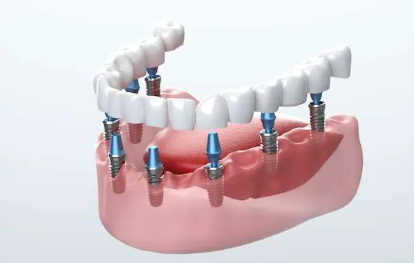 Alverna House Dental Practice: Transforming Smiles with Dental Implants in St Helens