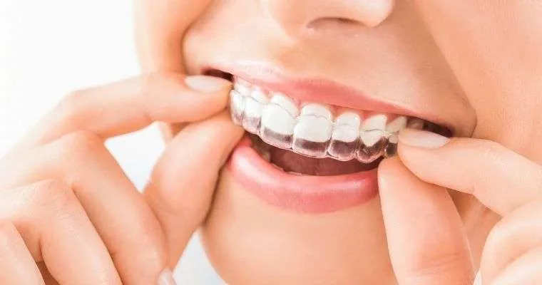 Composite Bonding
