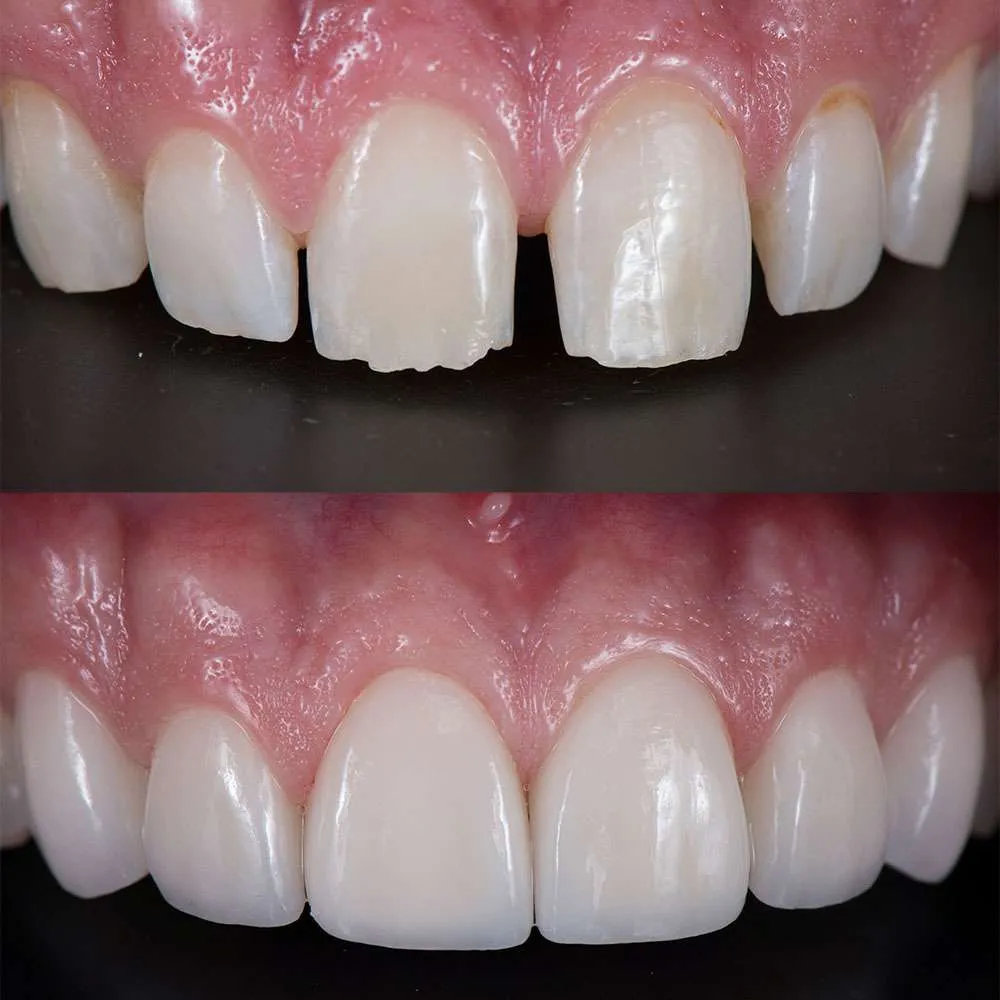 Composite Bonding