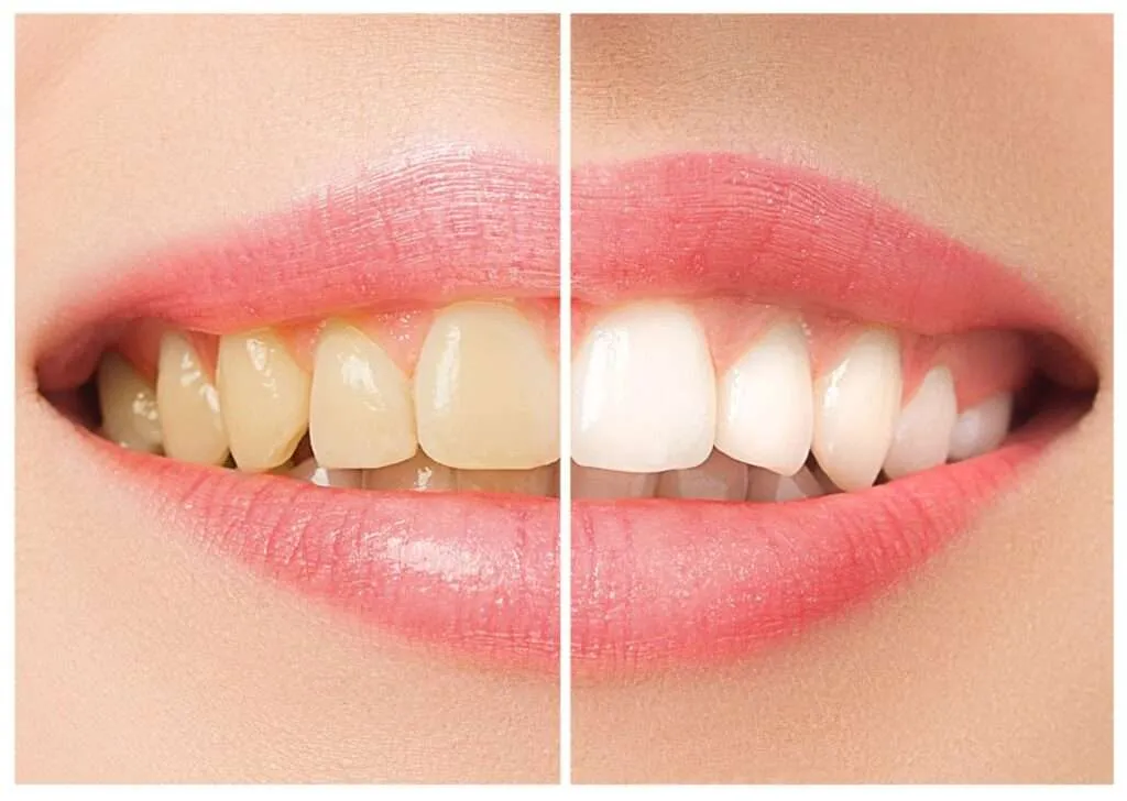 Pearly White Teeth
