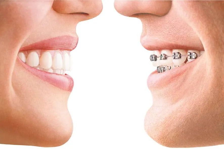 is invisalign better than braces