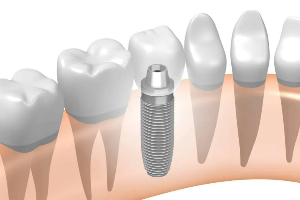 Dental Implants
