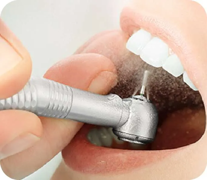 AIRFLOW Teeth Cleaning