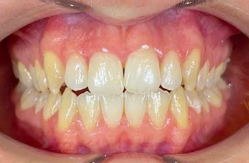 teeth whitening