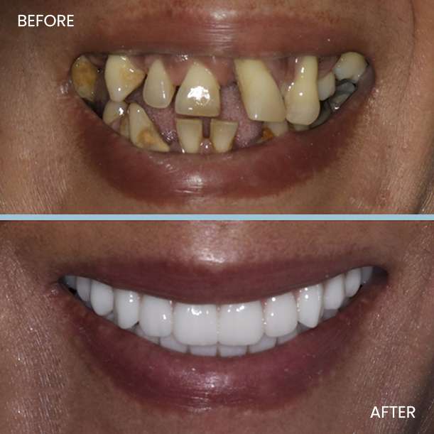 Dental Implant 1