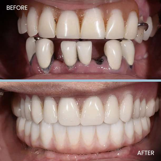 Dental Implant (3)