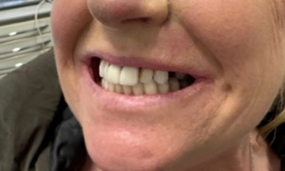 Dental Implant After 8