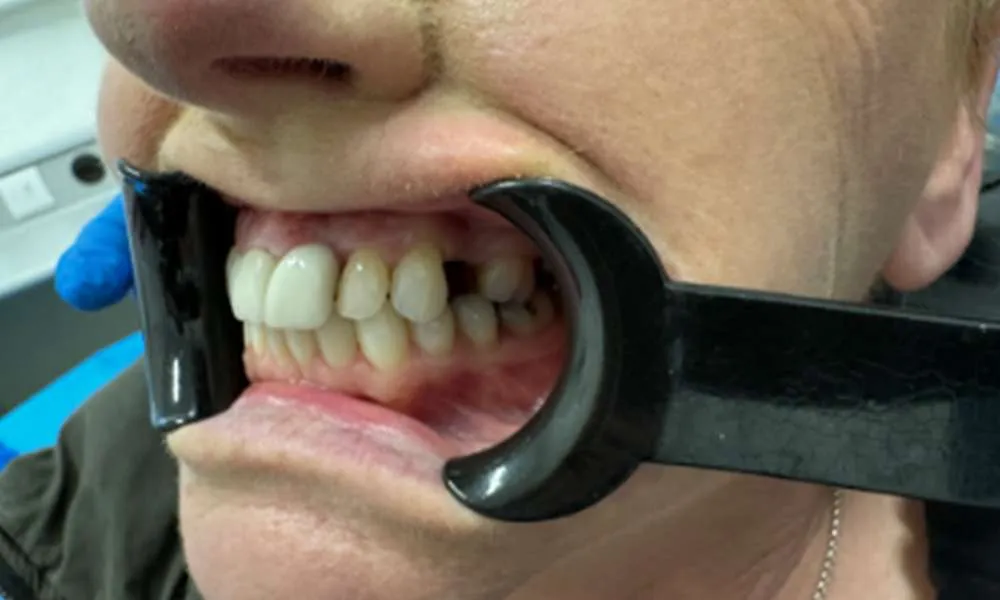 Dental Implant Before 8