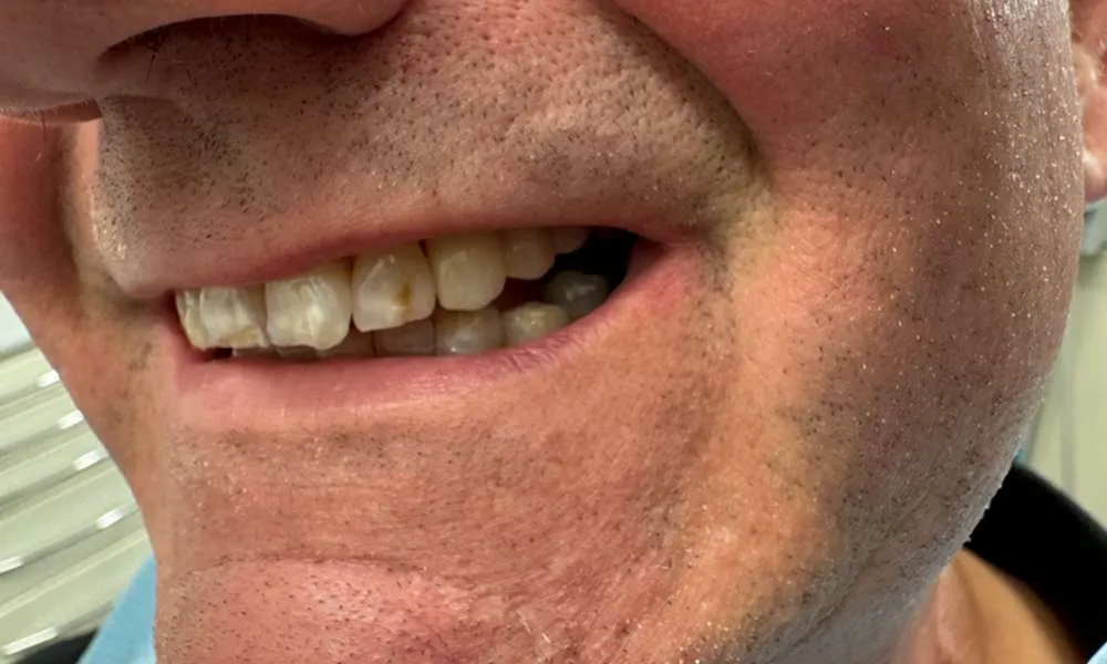 Dental Implants After 10