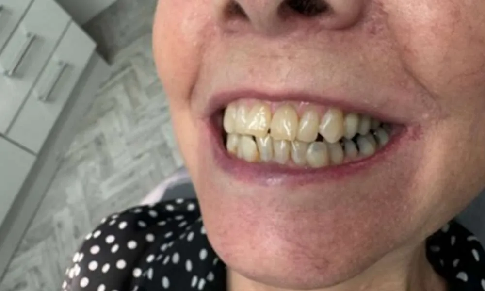 Dental Implants After 15