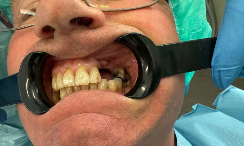 Dental Implants Before 10