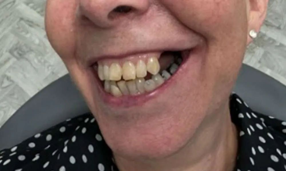Dental Implants Before 15