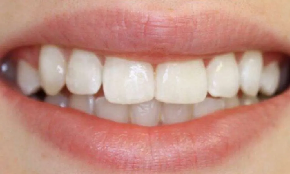 Teeth Whitening After 1