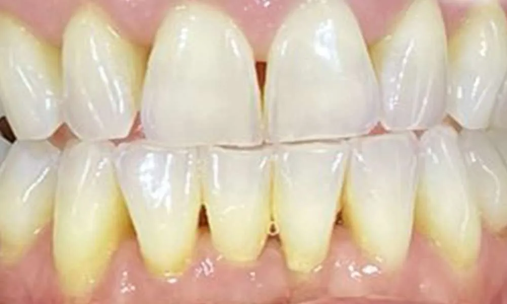 Teeth Whitening After 2
