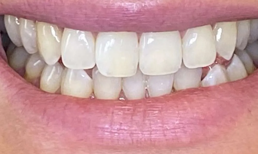Teeth Whitening After 3