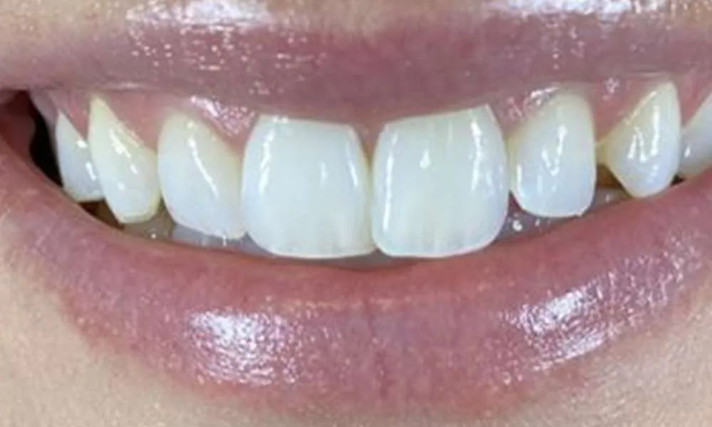 Teeth Whitening After 4