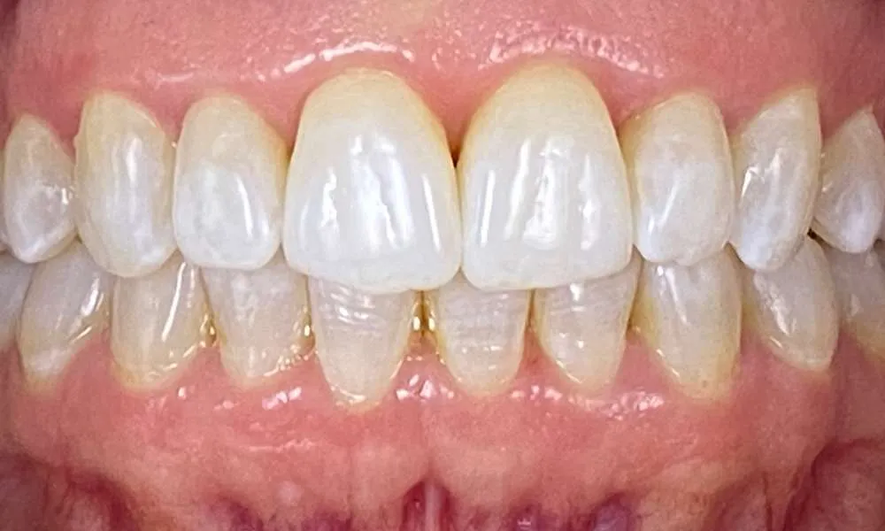 Teeth Whitening After 6