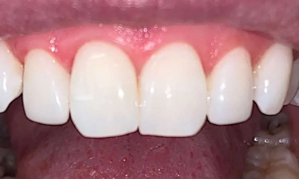 Teeth Whitening After 7