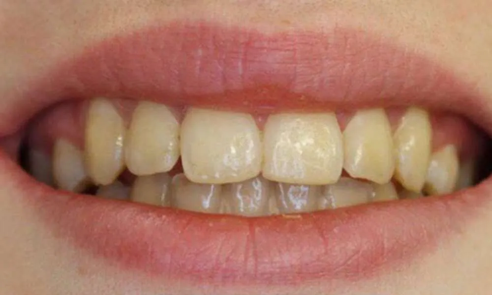 Teeth Whitening Before 1