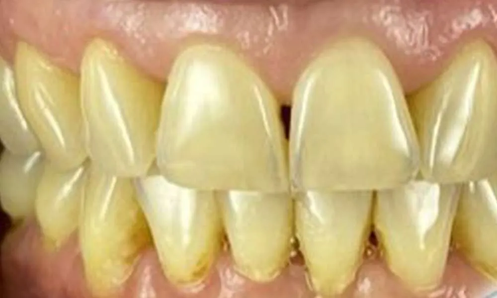 Teeth Whitening Before 2