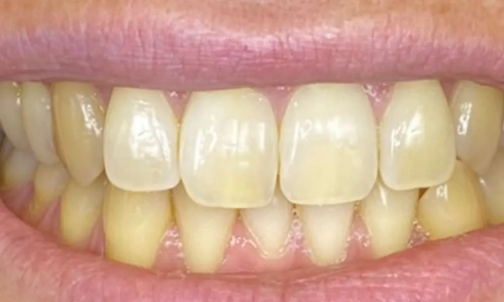 Teeth Whitening Before 3
