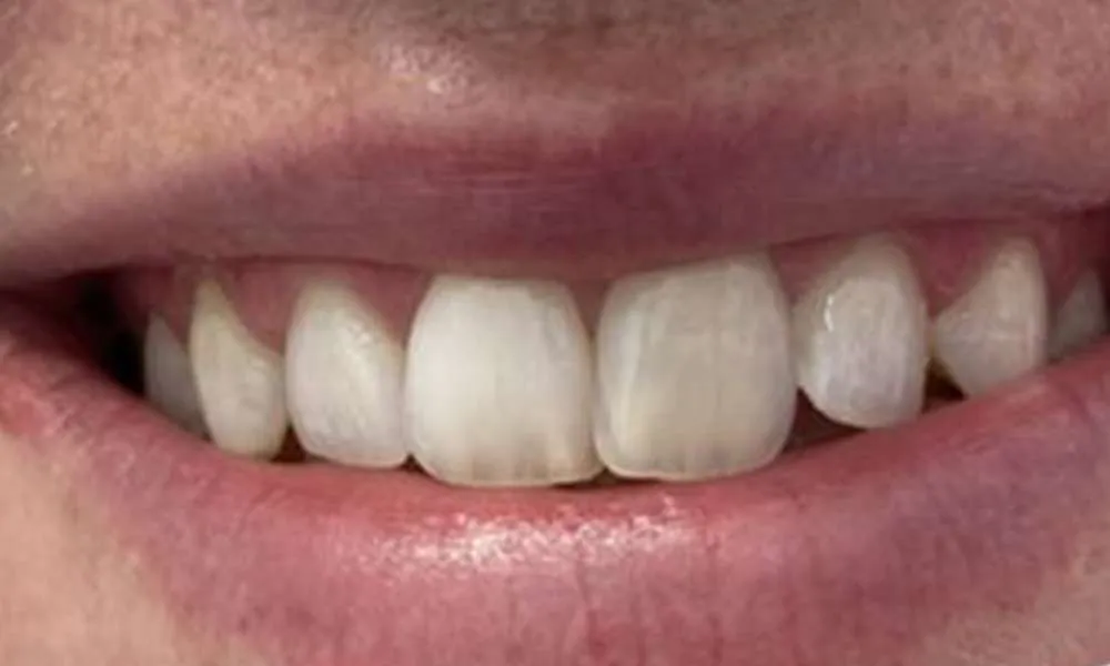 Teeth Whitening Before 4