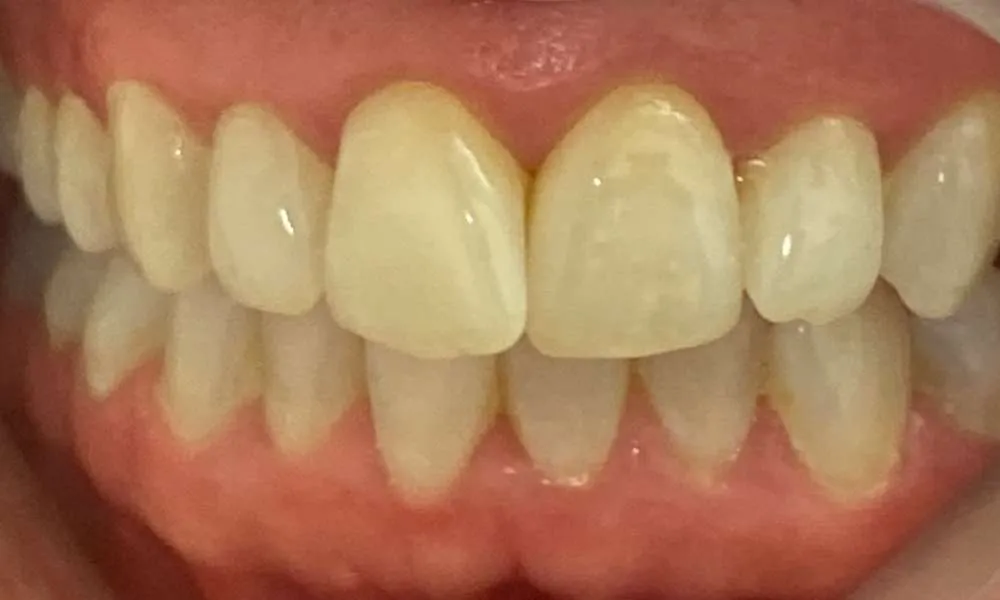 Teeth Whitening Before 6