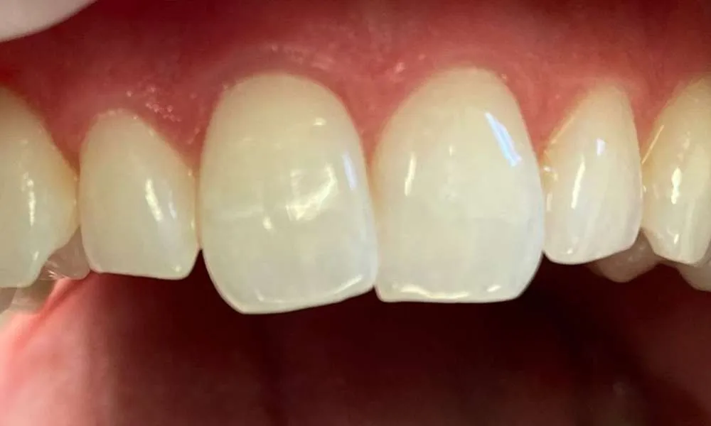 Teeth Whitening Before 7
