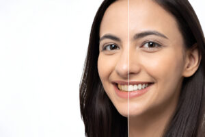 teeth whitening