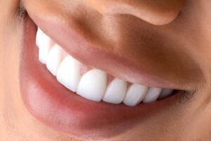 teeth whitening in St Helens,