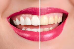 teeth whitening
