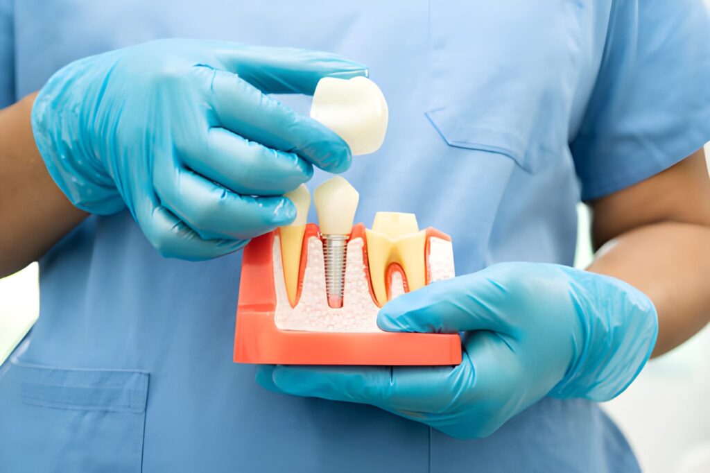 Dental Implants