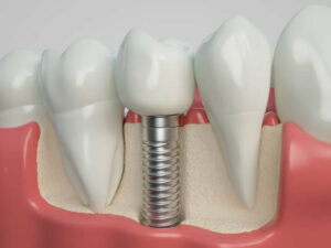 Dental Implants