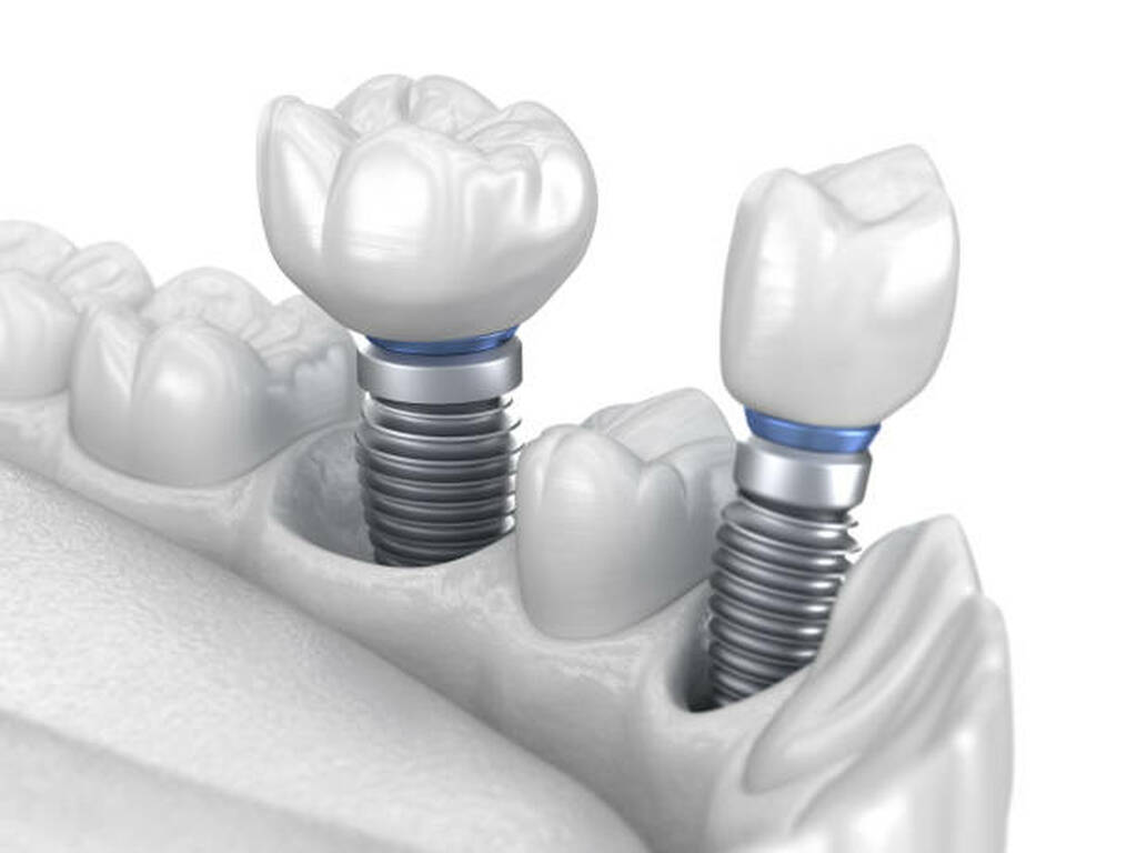 Dental Implant