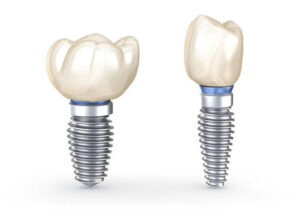 Dental Implants