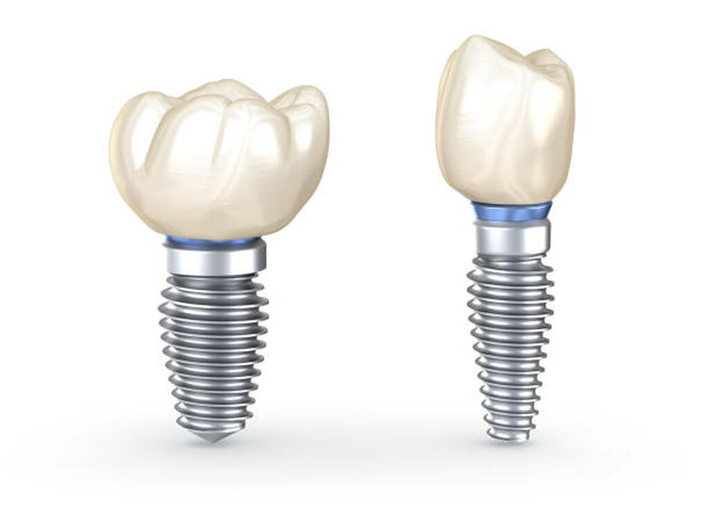Dental Implants