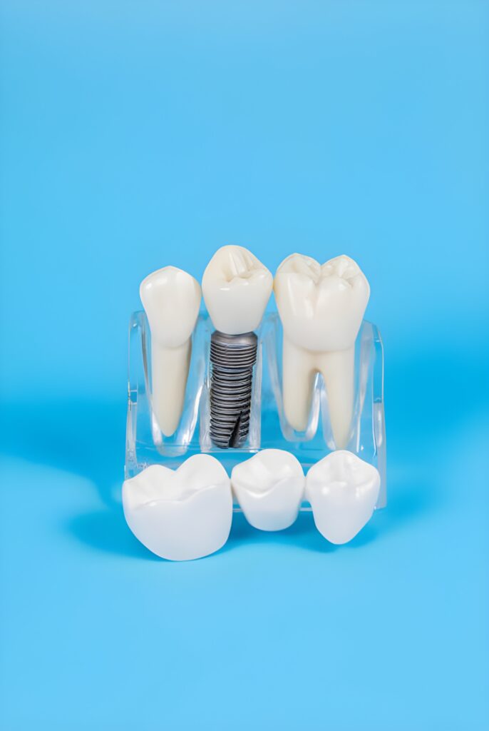 Dental Implants